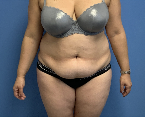 Tummy-Tuck-with-Liposuction--Case-Study-6201 | Before Liposuction